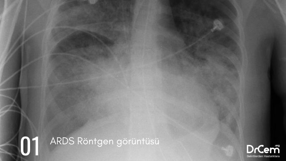 Akut Solunum Sıkıntısı ( ARDS) nedir ? görseli - DrCem hastalık rehberi